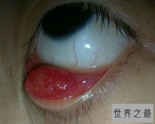 【图】麦粒肿就是咱们俗称的针眼，看一下麦粒肿图片