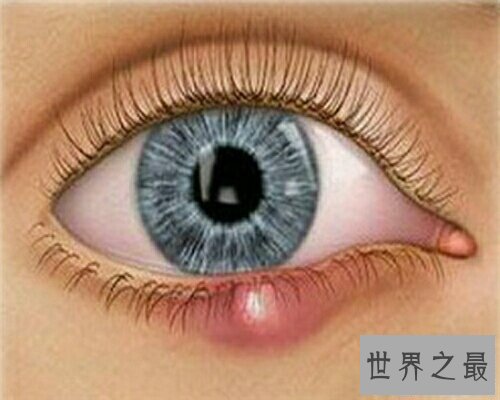 【图】麦粒肿就是咱们俗称的针眼，看一下麦粒肿图片
