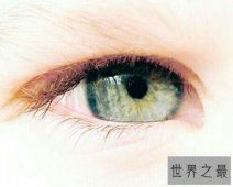 【图】麦粒肿就是我们俗称的针眼，看一下麦粒肿图片