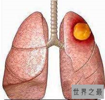 【图】肺心病——了解肺源性心脏病的点点滴滴