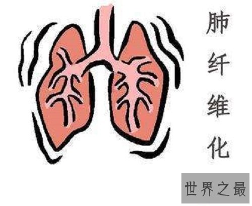 【图】肺纤维化——它会让你的生存不再有色调