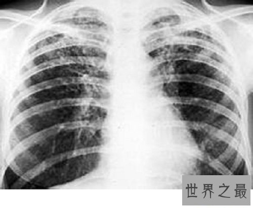 【图】肺纤维化——它会让你的生存不再有色调