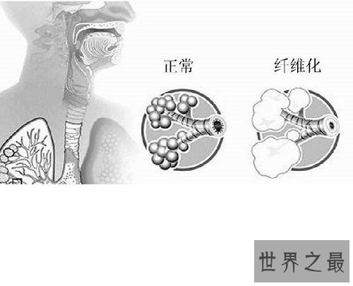 【图】肺纤维化——它会让你的生存不再有色调