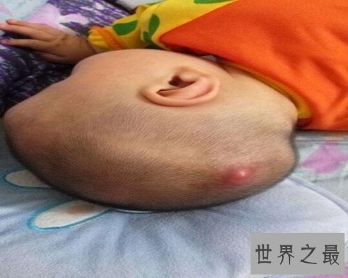 【图】比较常见的生殖系统出现的疾病——疖肿