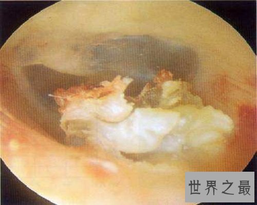 【图】比较常见的生殖系统出现的疾病——疖肿