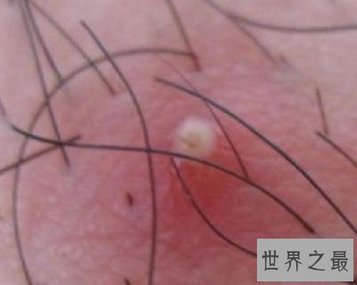 【图】比较常见的生殖系统出现的疾病——疖肿