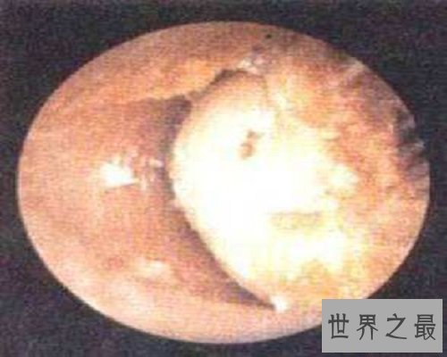 【图】比较常见的生殖系统出现的疾病——疖肿