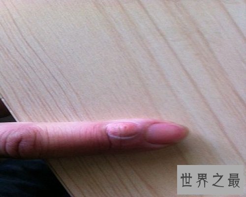 【图】比较常见的生殖系统出现的疾病——疖肿