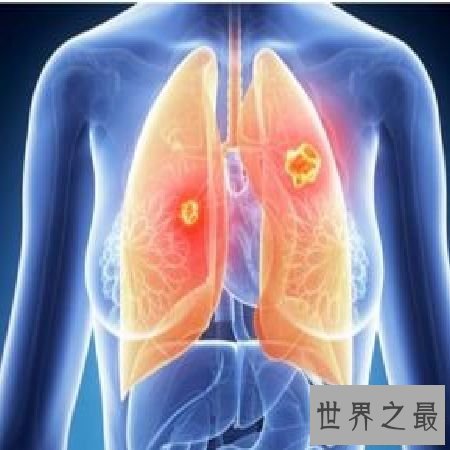 【图】 支气管扩张的那些事，你知道多少