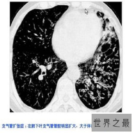 【图】 支气管扩张的那些事，你知道多少