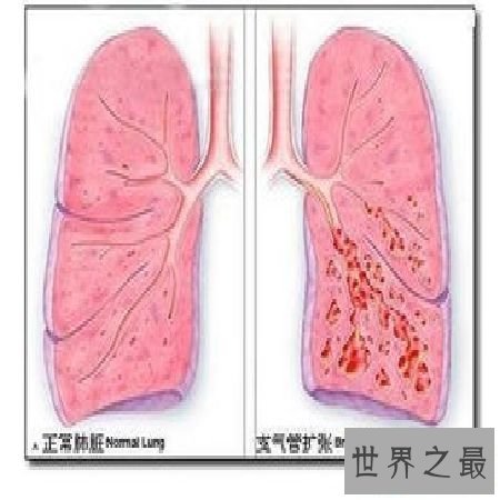 【图】 支气管扩张的那些事，你知道多少
