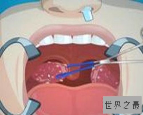 【图】扁桃体结石是什么情况？