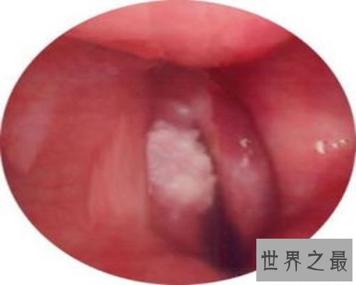 【图】扁桃体结石是什么情况？