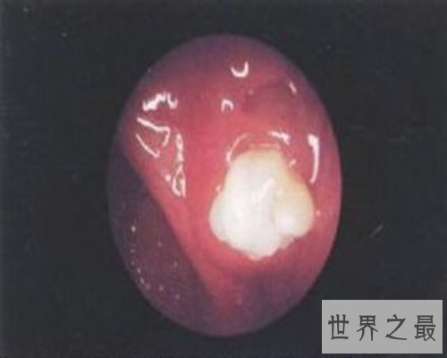 【图】扁桃体结石是什么情况？