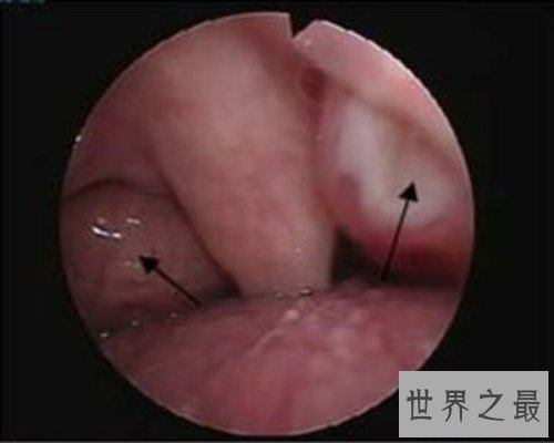 【图】扁桃体结石是什么情况？