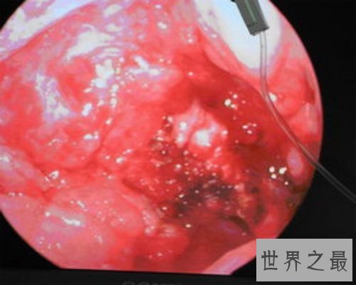 【图】扁桃体结石是什么情况？