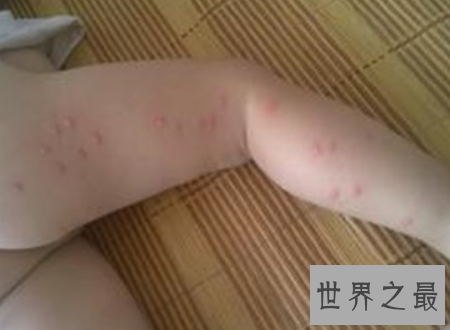 【图】花蚊子叮完之后应该如何解决能力避免传染病