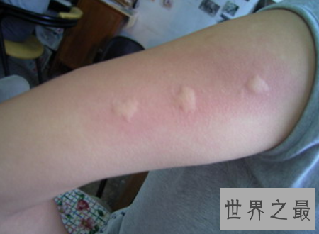 【图】花蚊子叮完之后应该如何解决能力避免传染病