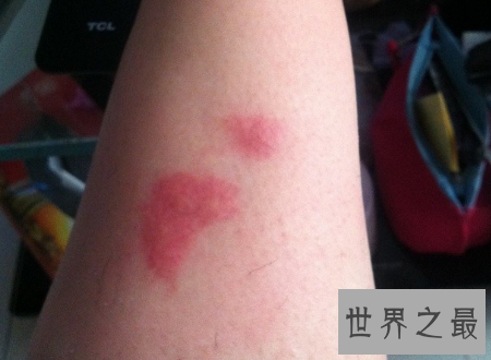 【图】花蚊子叮完之后应该如何解决能力避免传染病