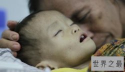 【图】艾滋病初期的症状，他们也是正常人，多点关心