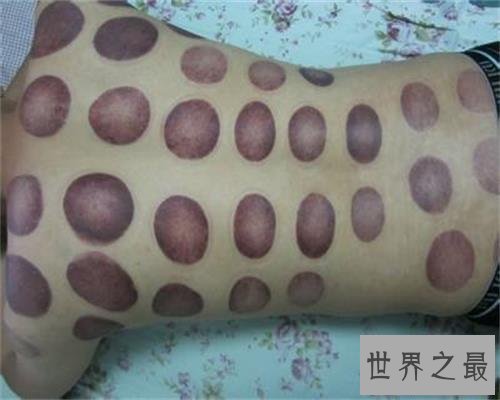 【图】拔罐后皮肤色彩甄别，了解你的瘦弱水平。