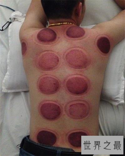 【图】拔罐后皮肤色彩甄别，了解你的瘦弱水平。