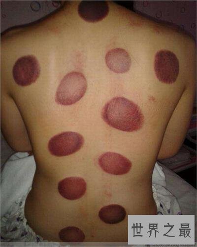 【图】拔罐后皮肤色彩甄别，了解你的瘦弱水平。