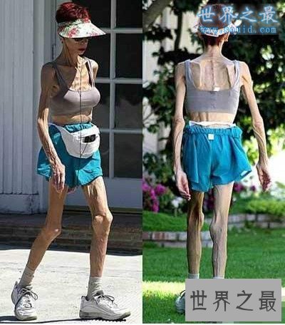 【图】世界上最瘦的人，减肥适度如干尸(只要20公斤)