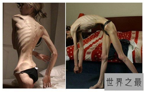 【图】世界上最瘦的人，减肥适度如干尸(只要20公斤)