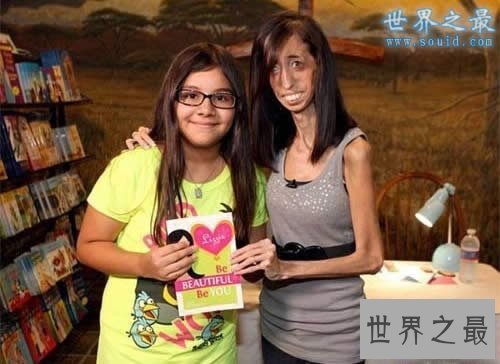 【图】世界上最瘦的人，减肥适度如干尸(只要20公斤)