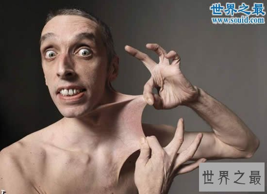【图】世界上皮肤最有弹性的人，下巴皮肤盖住嘴巴(图