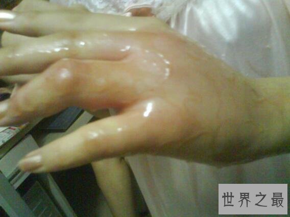 【图】世界上最毒的蚂蚁，红火蚁致人休克而死(附防治