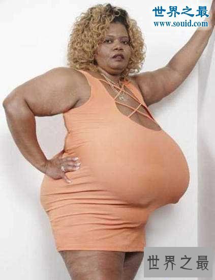【图】世界上最大的自然乳房，双乳重达77斤(图)