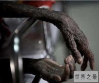 【图】世界上最早被发现的艾滋病 从美国发现的瘟疫之
