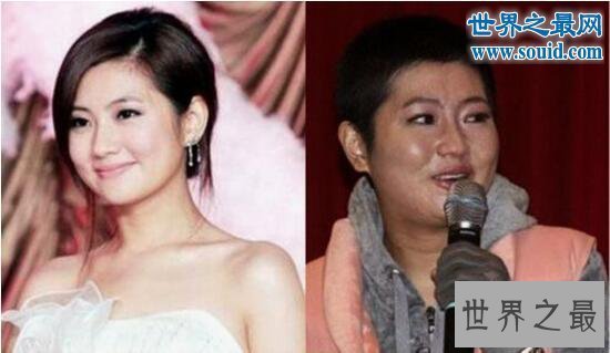 【图】selina烧伤前后对比，疤痕蜕变最美的花纹