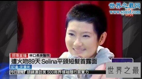 【图】selina烧伤前后对比，疤痕蜕变最美的花纹