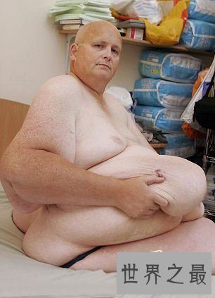 【图】世界上最胖的人减掉500斤肉，皮肤下垂吓死人