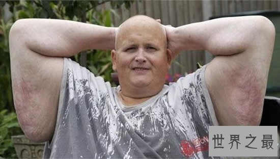 【图】世界上最胖的人减掉500斤肉，皮肤下垂吓死人