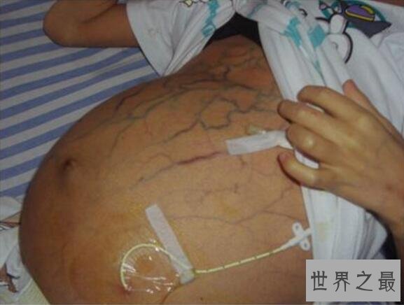 【图】最恶心的吸血虫图片，感染的人像是怀孕了(大肚