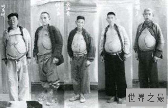 【图】最恶心的吸血虫图片，感染的人像是怀孕了(大肚