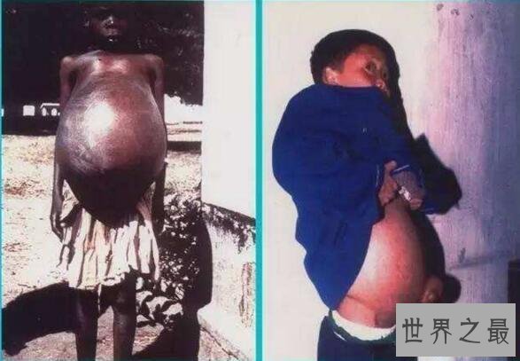 【图】最恶心的吸血虫图片，感染的人像是怀孕了(大肚