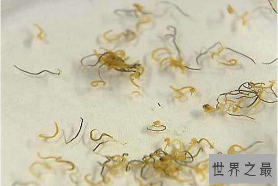 【图】最恶心的吸血虫图片，感染的人像是怀孕了(大肚