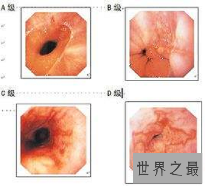 【图】你得胆汁反流性胃炎了吗？最佳治疗方法通知你