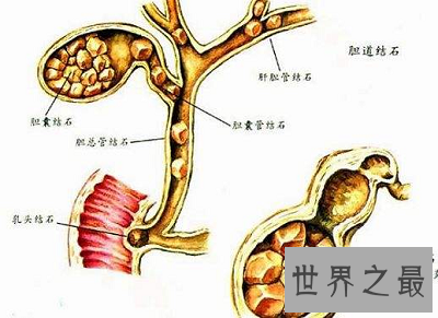 【图】你得胆汁反流性胃炎了吗？最佳治疗方法通知你