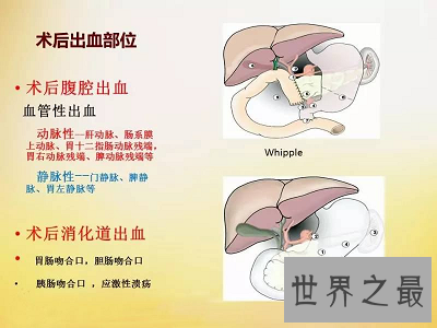 【图】你得胆汁反流性胃炎了吗？最佳治疗方法通知你