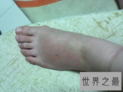 【图】你意识世界最毒蚊子吗？被毒蚊子咬了该怎样办