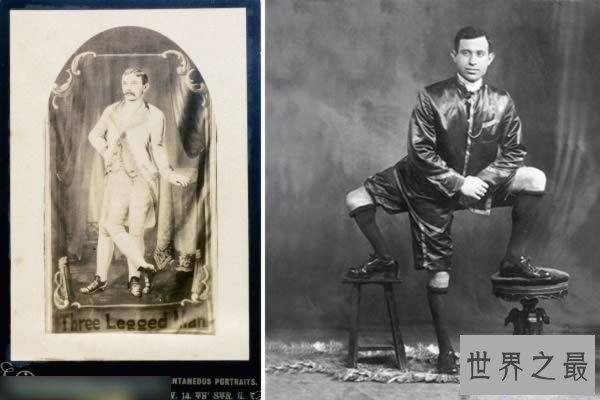 【图】世界10个领有多余性器官的人，双阴DAO双阴茎四个