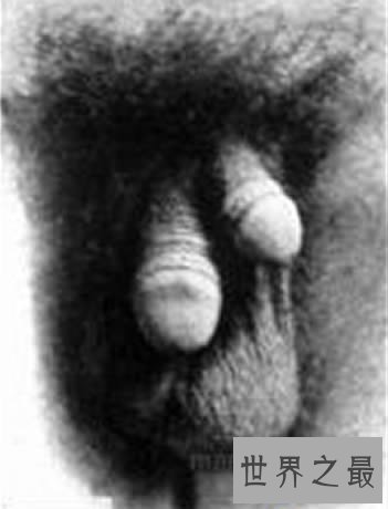 【图】世界10个领有多余性器官的人，双阴DAO双阴茎四个