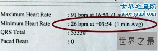【图】世界上心跳最慢的人，81岁英国老人(每分钟26下