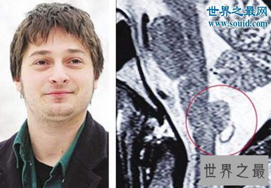 【图】打嗝工夫最长的人，查尔斯.奥斯本(不断打嗝68年